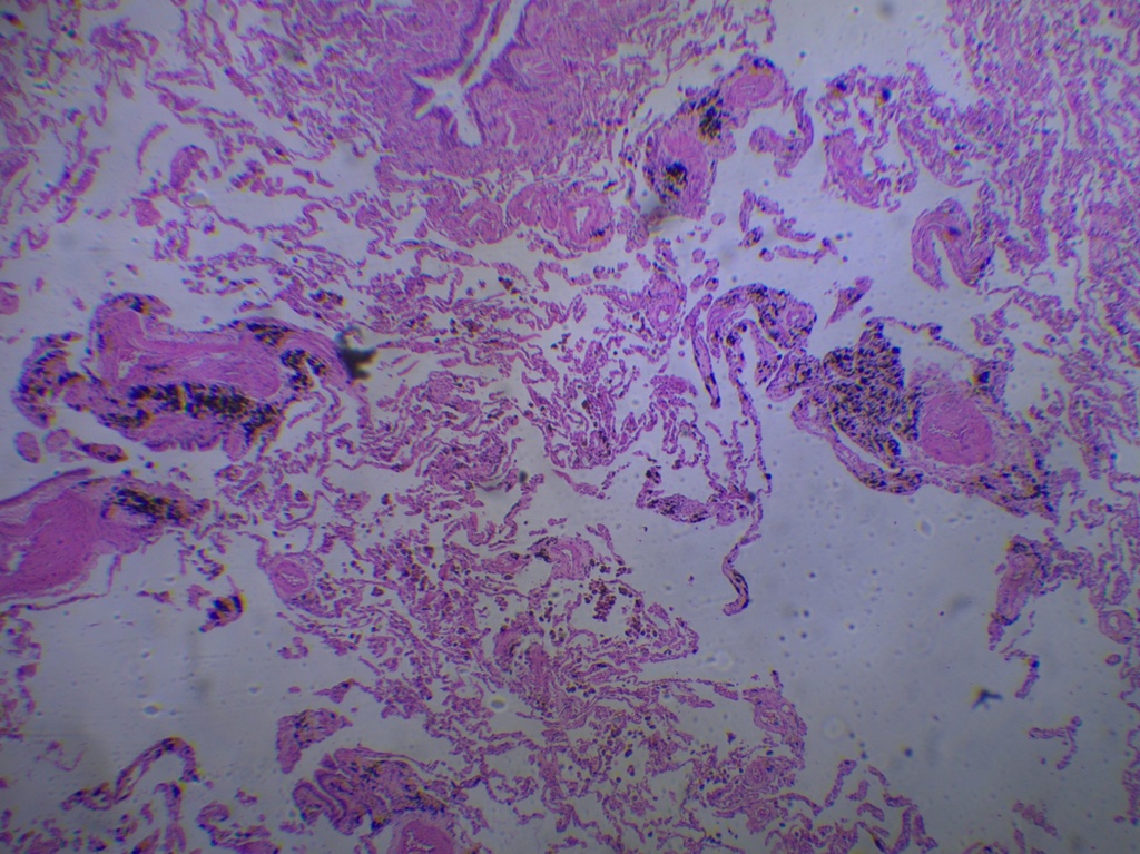 Pathologie - Poumon fumeur - Homme - Nublat