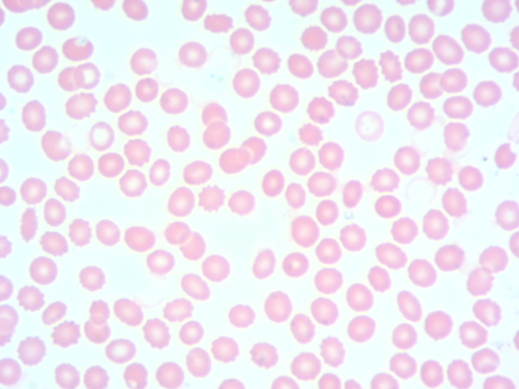 Sang humain giemsa Objectif semi-plan x10 G x100