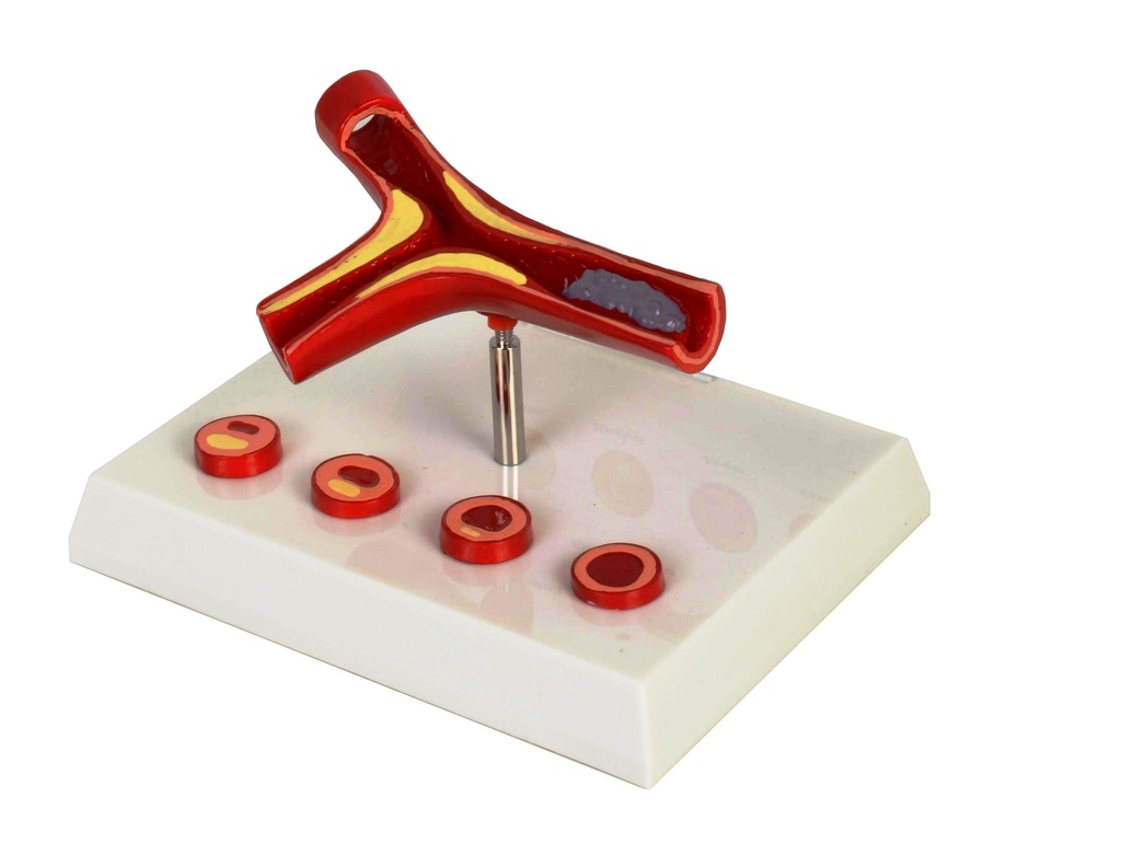 Modèle d'arthère avec athérome (athérosclérose)