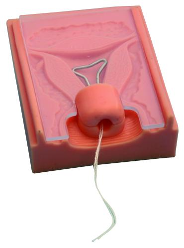 Modèle pose du stérilet 