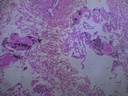 Préparation microscopique Nublat : Pathologie - Poumon fumeur - homme