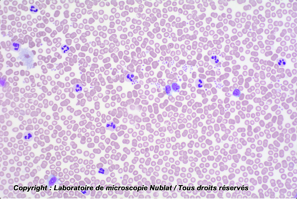 Préparation microscopique Nublat : Pathologie - Sang humain - septicémie 
