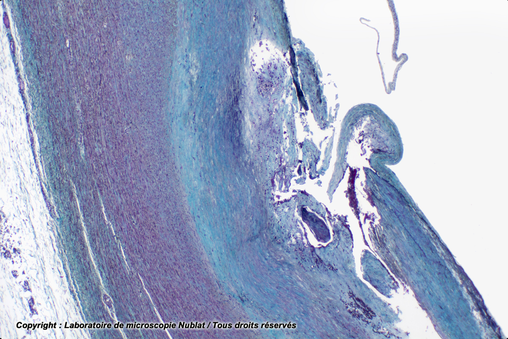 Artère (aorte) avec athérome - Nublat