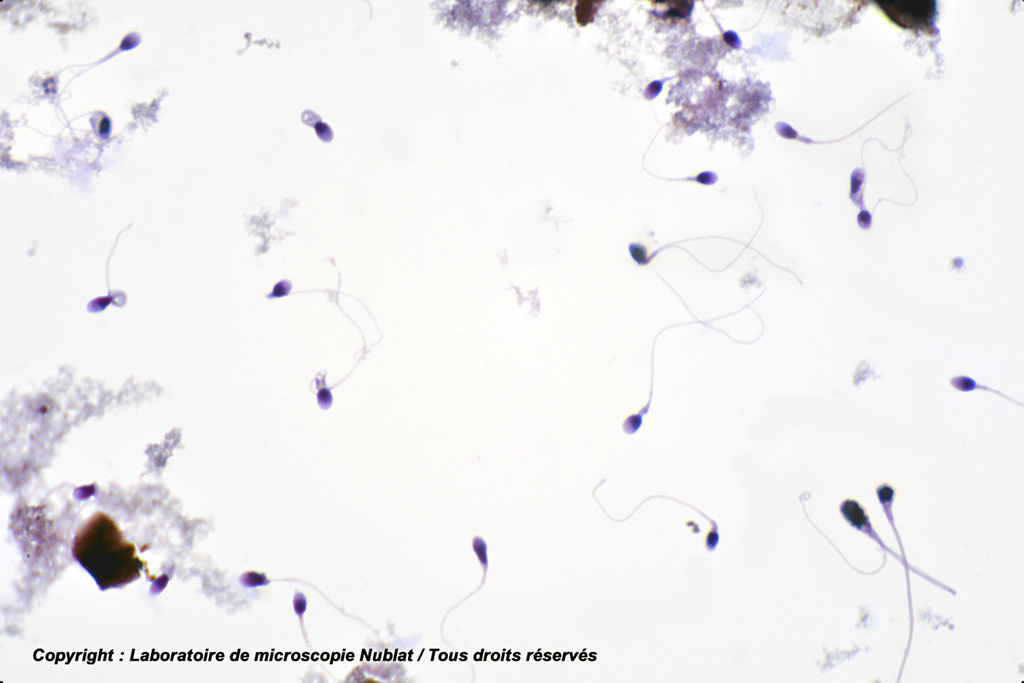 Spermatozoïdes pathologiques - homme - Nublat