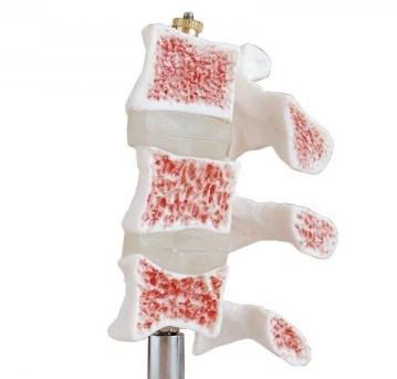 [023027] Modèle d'ostéoporose